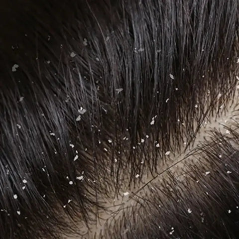 Dandruff